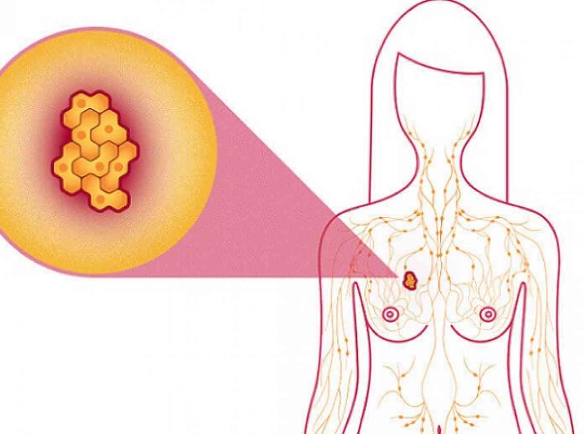 පියයුරු පිළිකා නසන එන්නතක් නිපදවයි