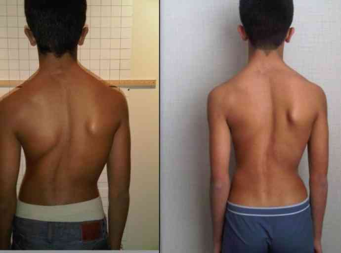 ශ්‍රී ලංකාවෙන් පැතිකුදය (Scoliosis) රෝග තත්වය තුරන් කිරීමේ මෙහෙයුමට පා ගමනක්